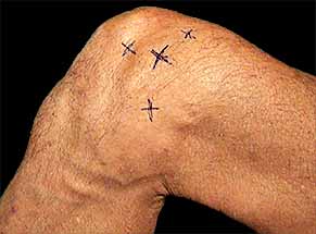 Marking painful spots on knee